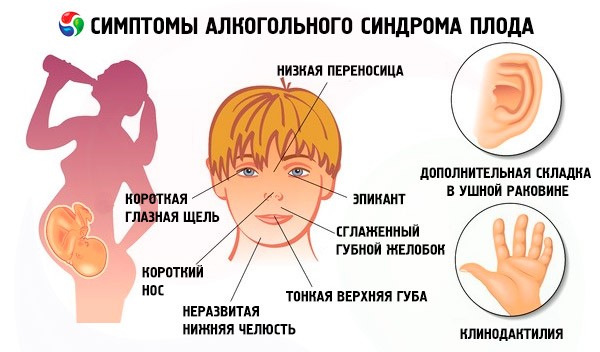 фото признаков фетального алкогольного синдрома (ФАС)