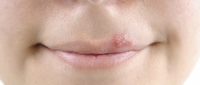 народные средства от герпеса на губах вылечить герпес на губах