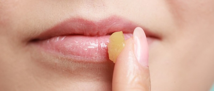 народные средства от герпеса на губах народная медицина при герпесе на губах