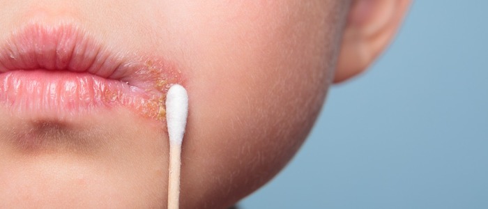 народные средства от герпеса на губах народная медицина при герпесе на губах