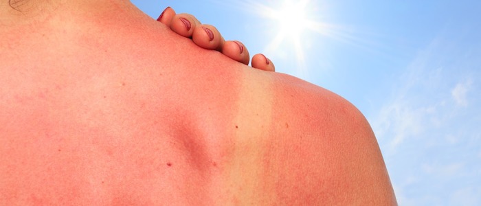 облезла кожа после загара облезла кожа после загара и чешется
