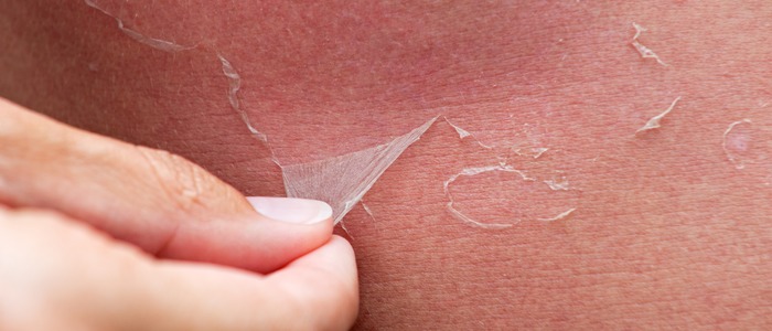 облезла кожа после загара облезла кожа после загара у ребенка