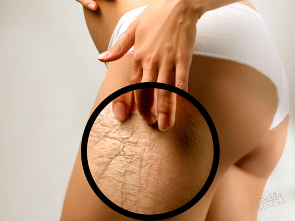 Растяжки удаление Растяжки на животе