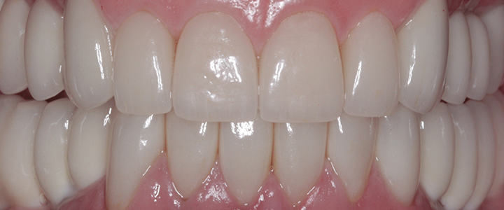 Композитные виниры Виниры