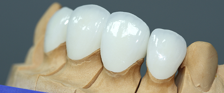 Керамические виниры Виниры для зубов