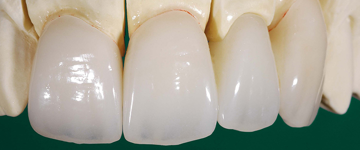 Циркониевые виниры Виниры на зубы