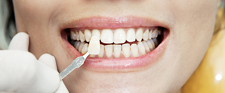 Виниры на передние зубы Виниры на зубы